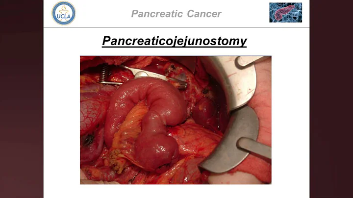 Pancreatic Cancer in 2016 - Timothy R. Donahue, MD...