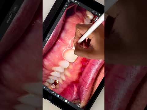 Video: Doen mondchirurge kroonverlenging?