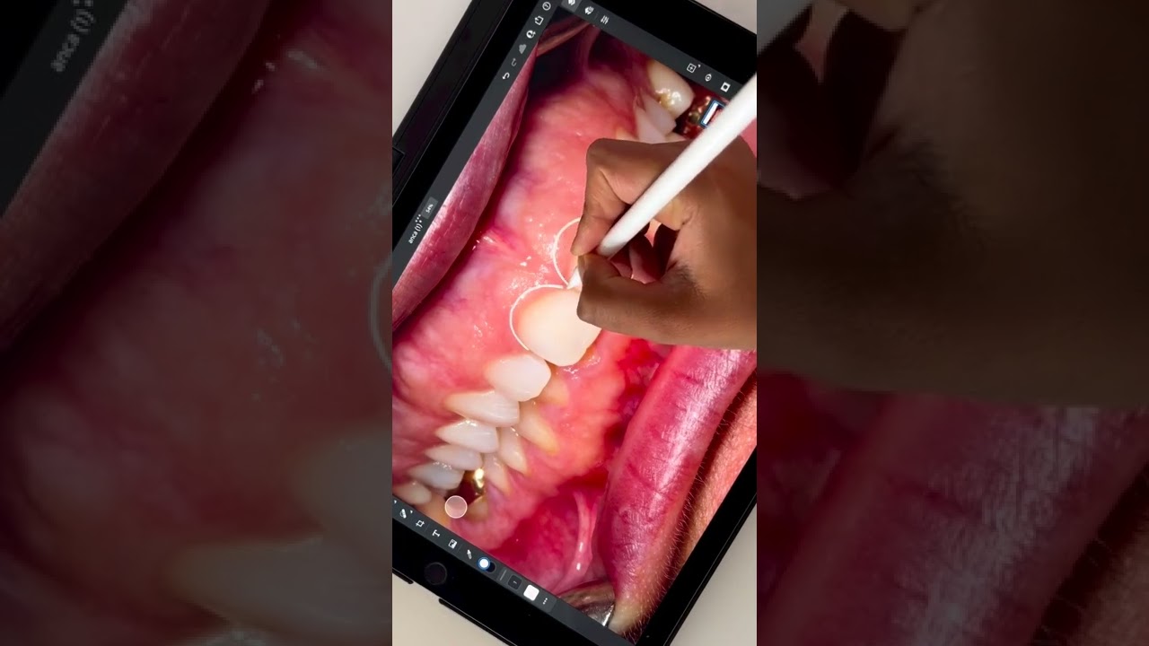 Crown Lengthening Treatment London 