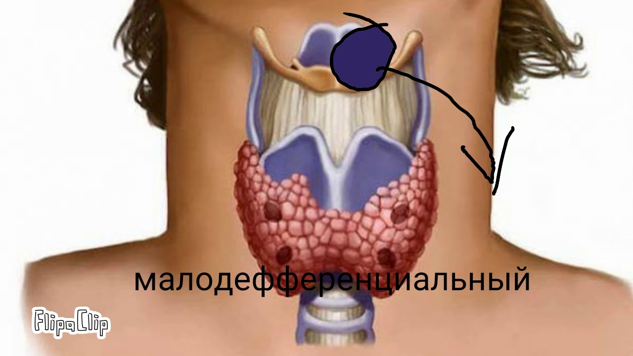 Щитовидной Железы Что Это Такое Фото