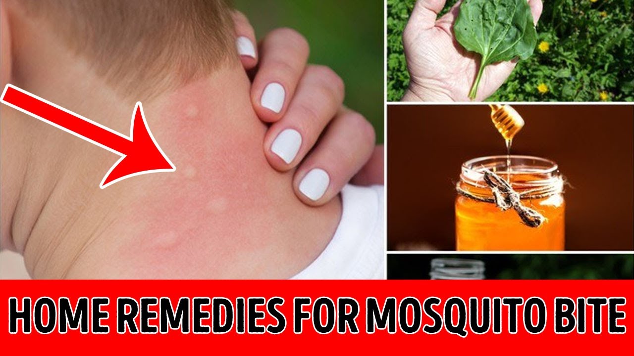 How to treat mosquito bites home remedies for mosquito bite YouTube