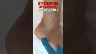 🚨Cortisone al piede? Ferma tutto! | Dott. Andrea Scala