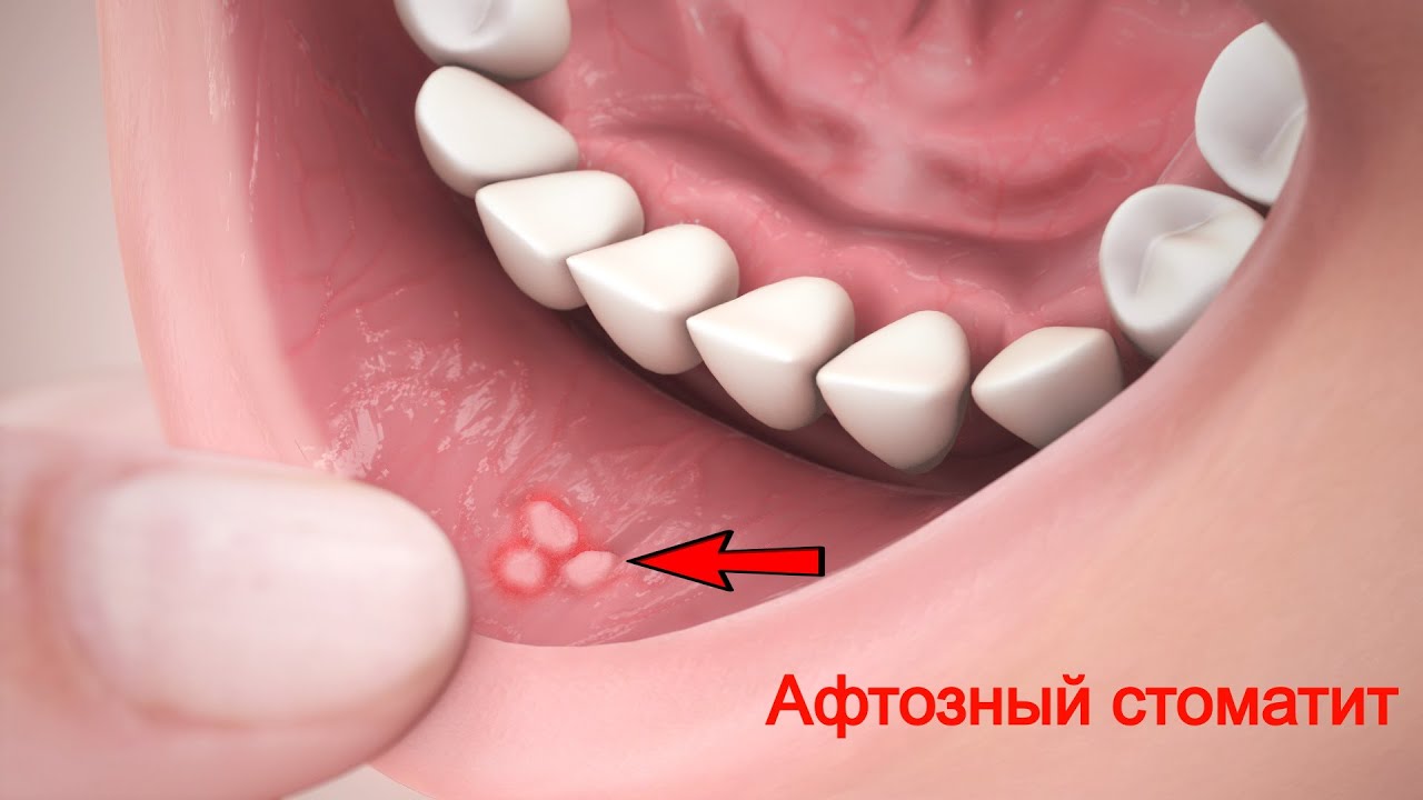 Афтозный Стоматит. Причины, Симптомы и Лечение