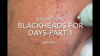 Blackheads for days part 1. 12 minutes of just the pop.acne extractions. Pimple popping.waxy plugs