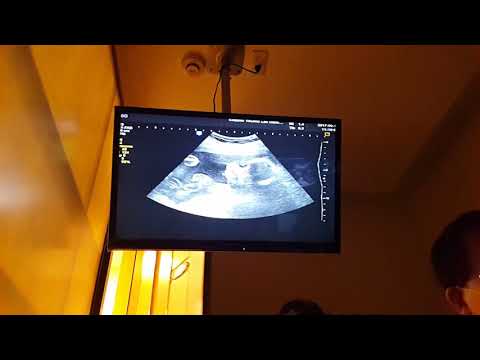 20170919 林正宗 23+6 喬治寶寶產檢