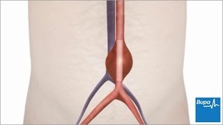 How open abdominal aortic aneurysm surgery is carried out