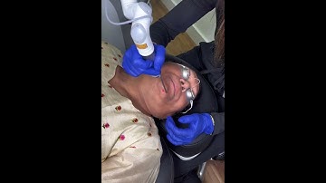 Pico laser treatment is the best procedure for a home struggling with melasma 💥