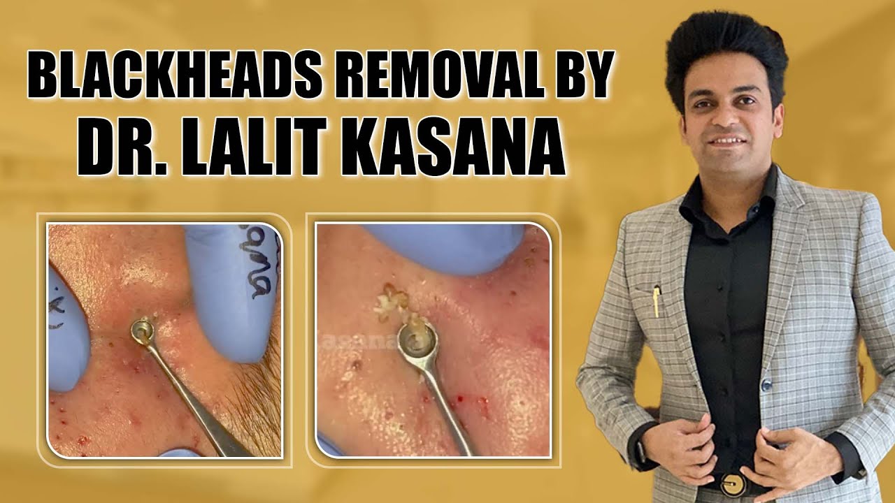 BLACKHEAD PIMPLES REMOVAL Dr Lalit Kasana This week Blackheads