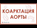 Коарктация аорты