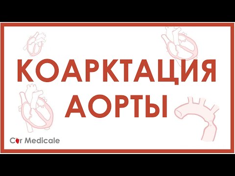 Видео: Является ли коарктация аорты синюшной?