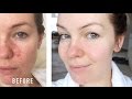 HOW I CURED MY ROSACEA // IRRITATION // REDNESS // MY STORY