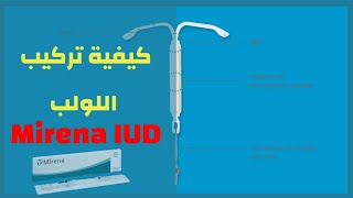 طريقة تركيب اللولب | Mirena IUD