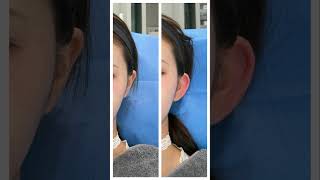 이다클리닉 #엘프귀필러 #접힌귀# 이다클리닉.    Https://www.idaclinic.kr