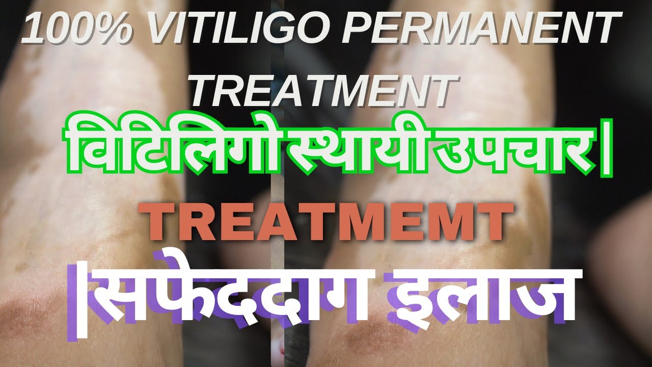 100% VITILIGO PERMANENT TREATMENT |100%VITILIGO COLOUR MATCHING\ विटिलिगो स्थायी उपचार|सफेददाग इलाज