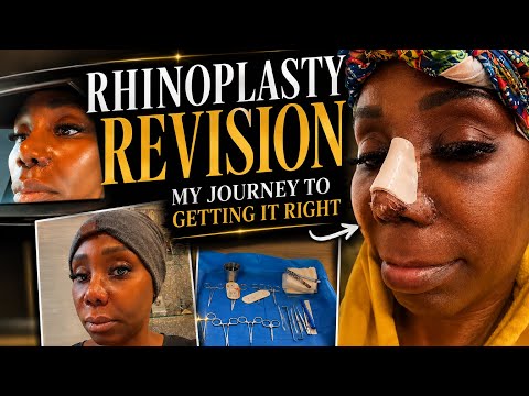 Thumbnail for DAYS IN MY LIFE: Nose job revision  procedure, Let the foolery begin,  Life’s unexpected turn
