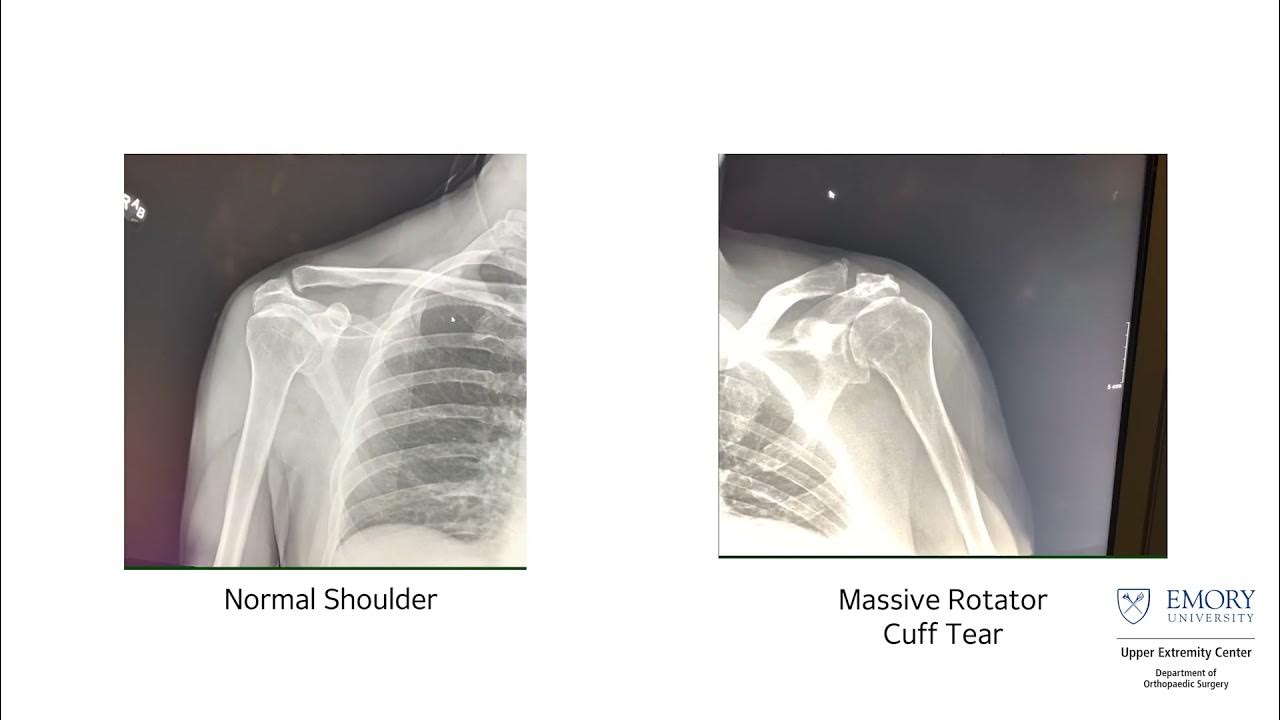Rotator Cuff Tear Case Study DDR Applications Konica Minolta