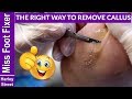 The right way to remove callus and corns - FULL TREATMENT