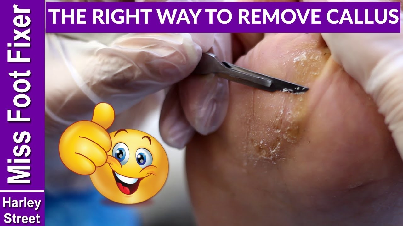 Callus Removal At Home: 5 Top Tips - Northwich Foot Clinic