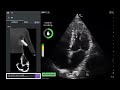 Caption AI Vscan Air SL - Automated Ejection Fraction