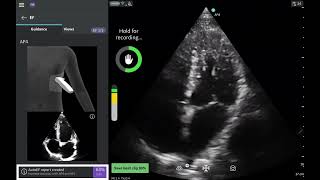 Caption AI Vscan Air SL - Automated Ejection Fraction