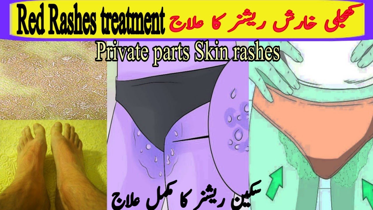 How to Jock itch Treatment Red Rashes Treat کھجلی خارش ریشز کا علاج Pak health care tv