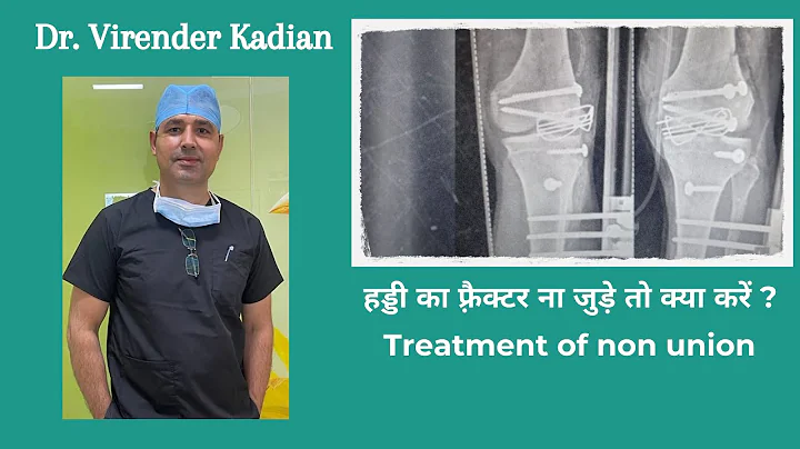 ? Treatment of non-union  by Dr Virender Kadyan Ma...
