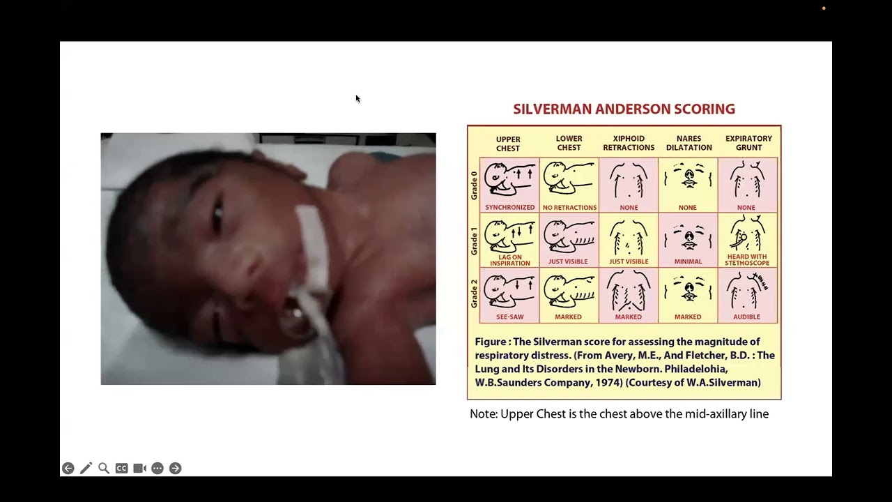 Respiratory Distress in the Newborn