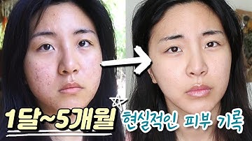 여드름약 먹으면서 매일 기록한 5개월 간의 변화 과정