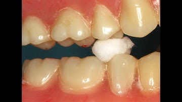 The Chew Test  - Diagnosing & Adjusting Denture Occlusion