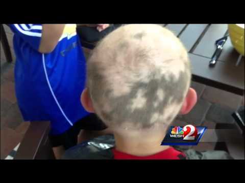 Teacher shaves head to support student with Alopecia