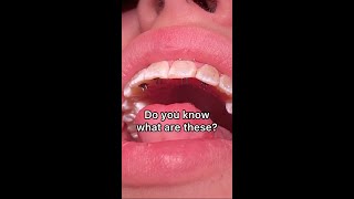 Braces on- Tongue Thursting Problem- Do you know what are these? - Tooth Time Family Dentistry