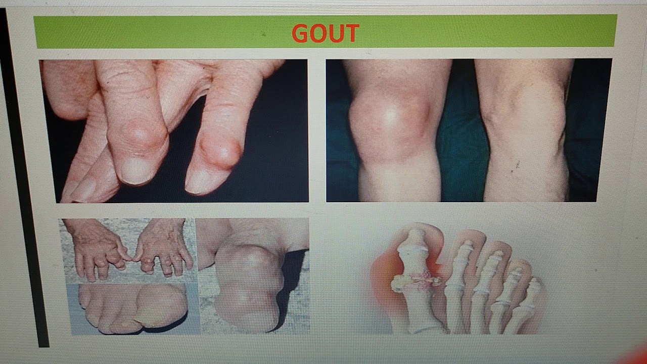 Massage Therapy Study Guide 8 THE INFLAMMATORY ARTHRITIDES YouTube