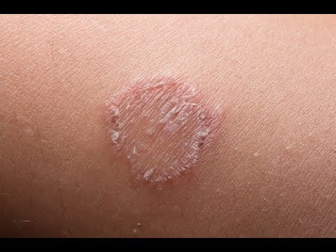 Video: Hautmykose - Fotos, Symptome, Ursachen Und Behandlung Von Hautmykose