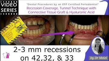 Recession Coverage Tunnel Technique with Connective Tissue Graft and Hyaluronic Acid