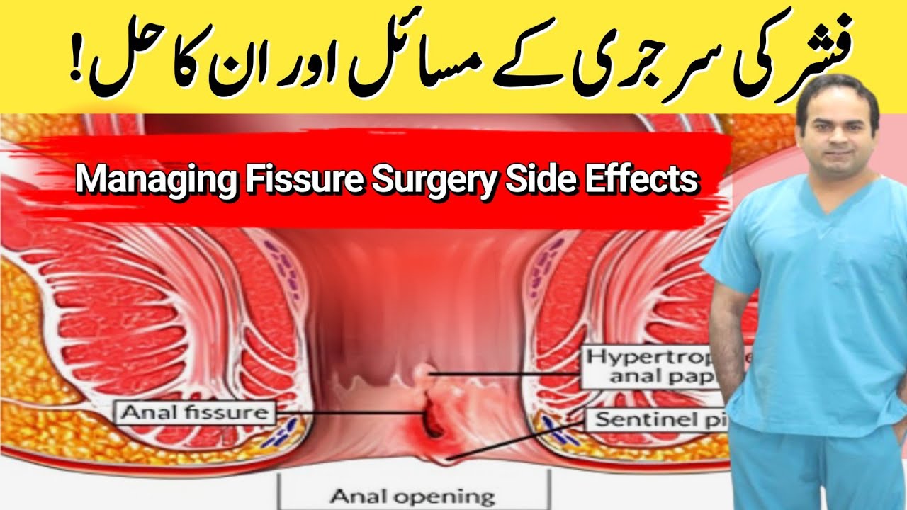 Post - Fissure surgery solution | Managing fissure surgery side effects ...