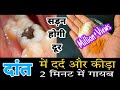 2 मिनट में दांत का दर्द और कीड़ा बाहर निकालने का अचूक उपाय Get rid of Tooth cavity germ, tooth decay