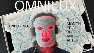 The Truth About OMNILUX - My 6 Month Skin Journey