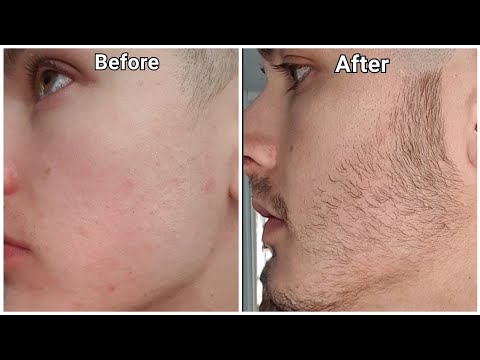 Minoxidil Beard Growth - 3 Month Transformation - BEFORE and AFTER