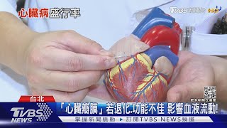 提高警覺! 「瓣膜性心臟病」輕忽這些症狀...死亡風險高十點不一樣20220121