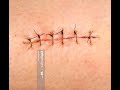 Tuto sutures simples