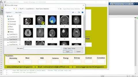 Brain Tumor Detection using Image Processing FINAL YEAR PROJECT
