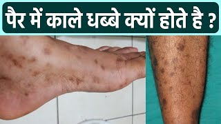 पर म कल धबब हन क करण पर पर कल नशन क करण Pair Me Kale Dhabbe Hona Boldsky