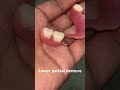 Lower partial denture 😬😬😬#splittooth #apexdental #dentistry #partialdenture #orthodontist