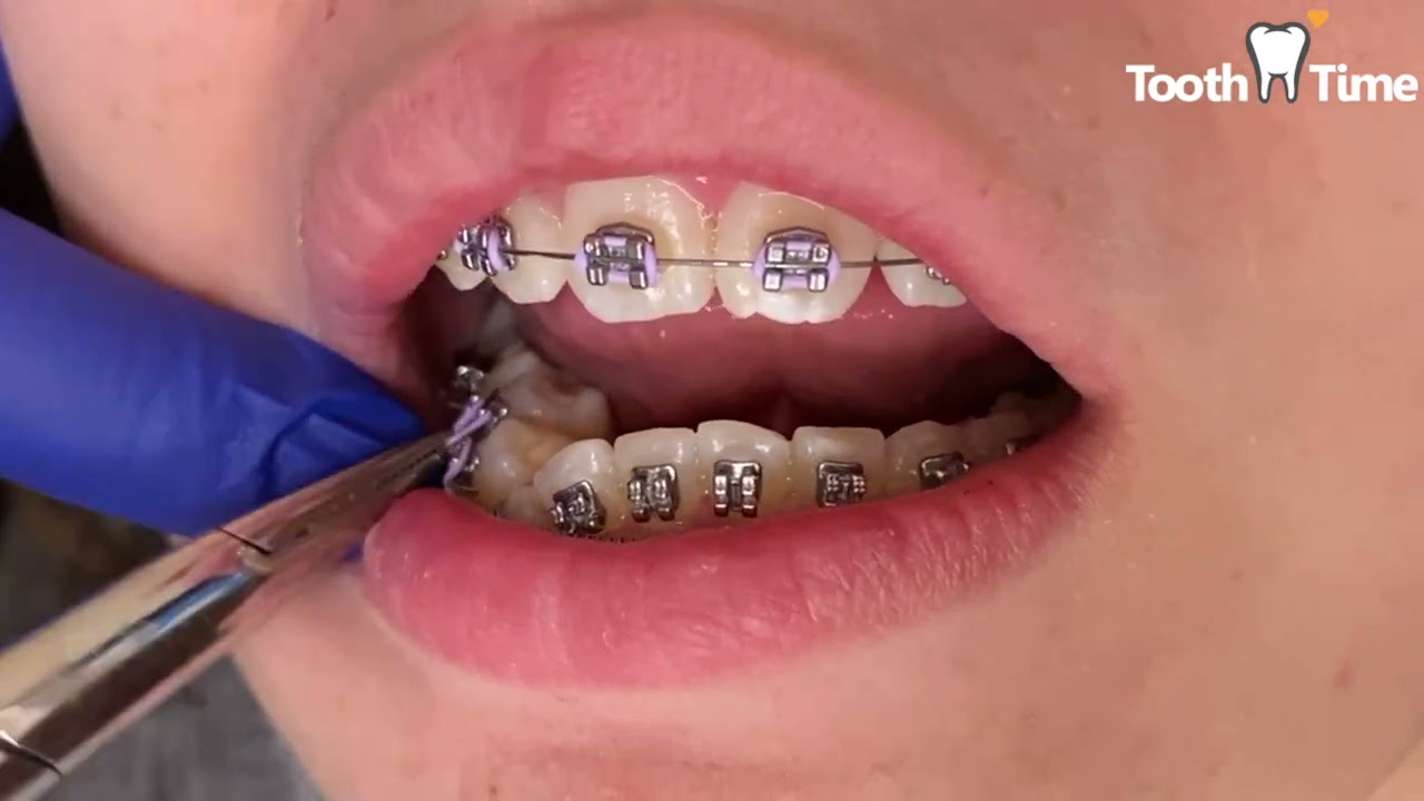 Braces Check up - Wire change 19x25 SS to 018SS - Tooth Time Family  Dentistry New Braunfels 