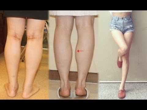 Video 3 bước biến chân voi, đùi to trở nên thon gọn, săn... - youtube