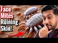 How to Get Rid of Face Mites Fast | Easy Face Mites Removal