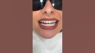 Upper & Lower Composite Bonding Makeover ❤️