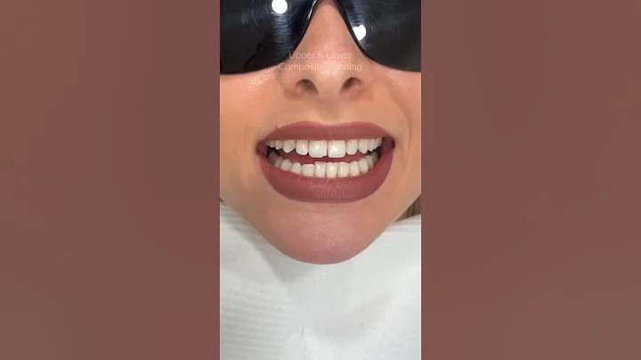 Upper & Lower Composite Bonding Makeover ❤️