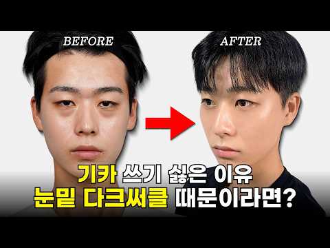 Encore Lower Blepharoplasty! All the young celebrities are getting