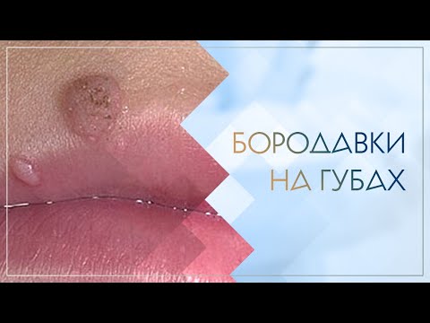 😟 Бородавки на губах. Клинический случай №52